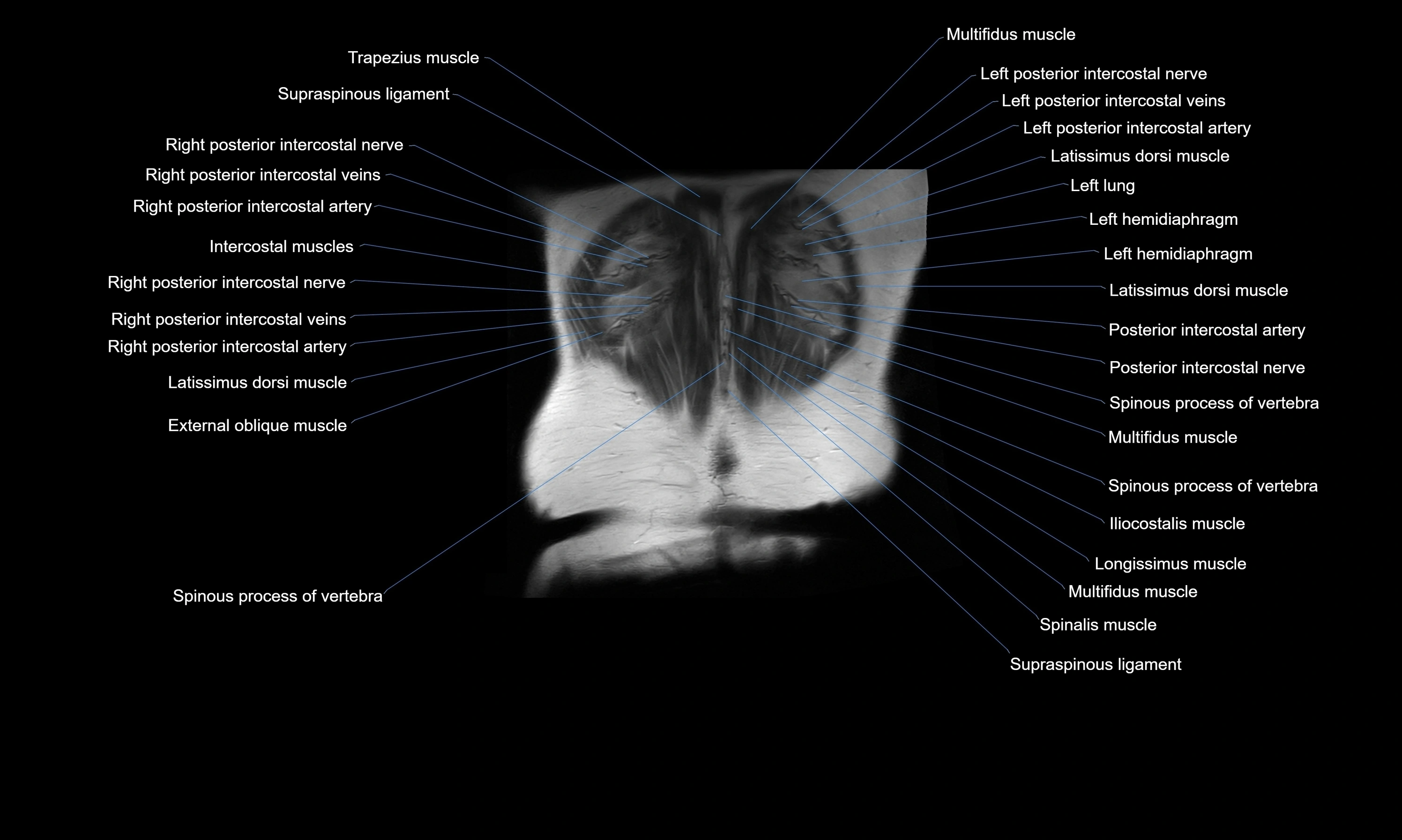 MRI Abdomen axial cross sectional anatomy radiology  image-img-00001-00054.webp